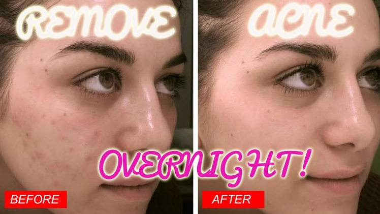 How to Get Rid of Acne Overnight Guaranteed