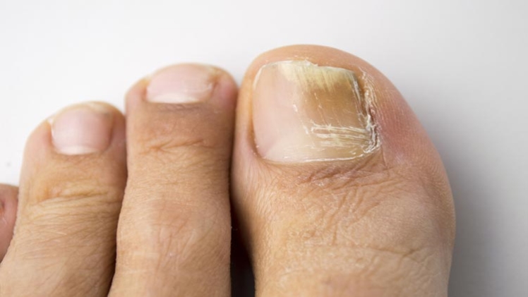 Fungal Nail Infection Treatment